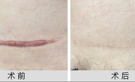 剖腹产会留疤吗